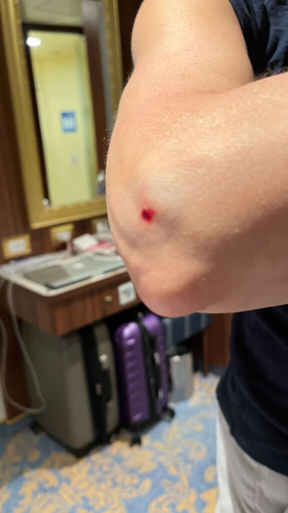 My minor injury from one of the slides at Damajagua 27 Falls in the Dominican Republic because I did not pull my elbows in far enough when I crossed my arms. It was no big deal and totally worth it!